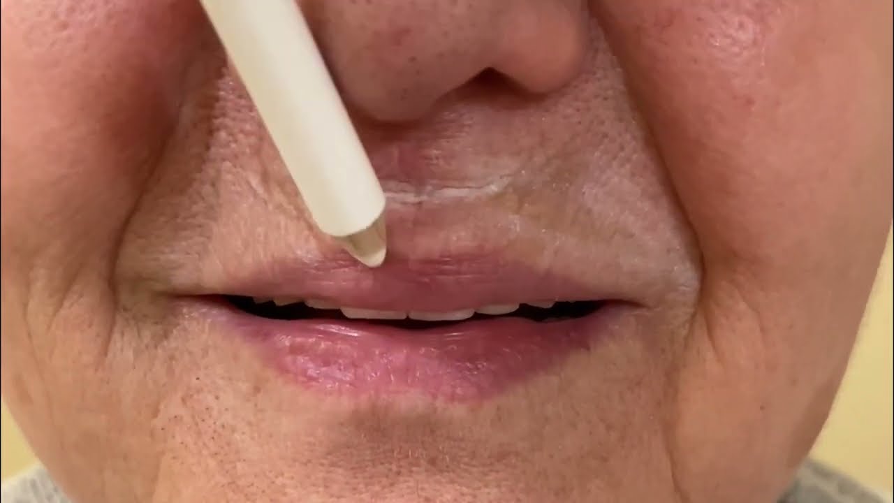 ácido hialurónico código de barras antes y después