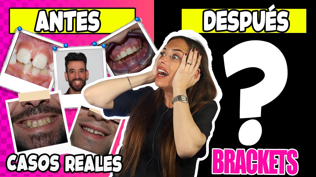 antes y despues de la ortodoncia fotos