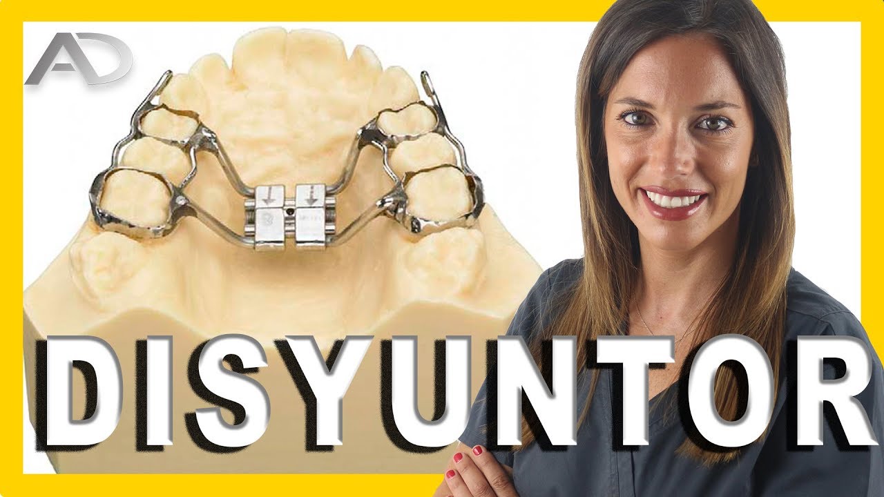 aparato para ensanchar el paladar en niños