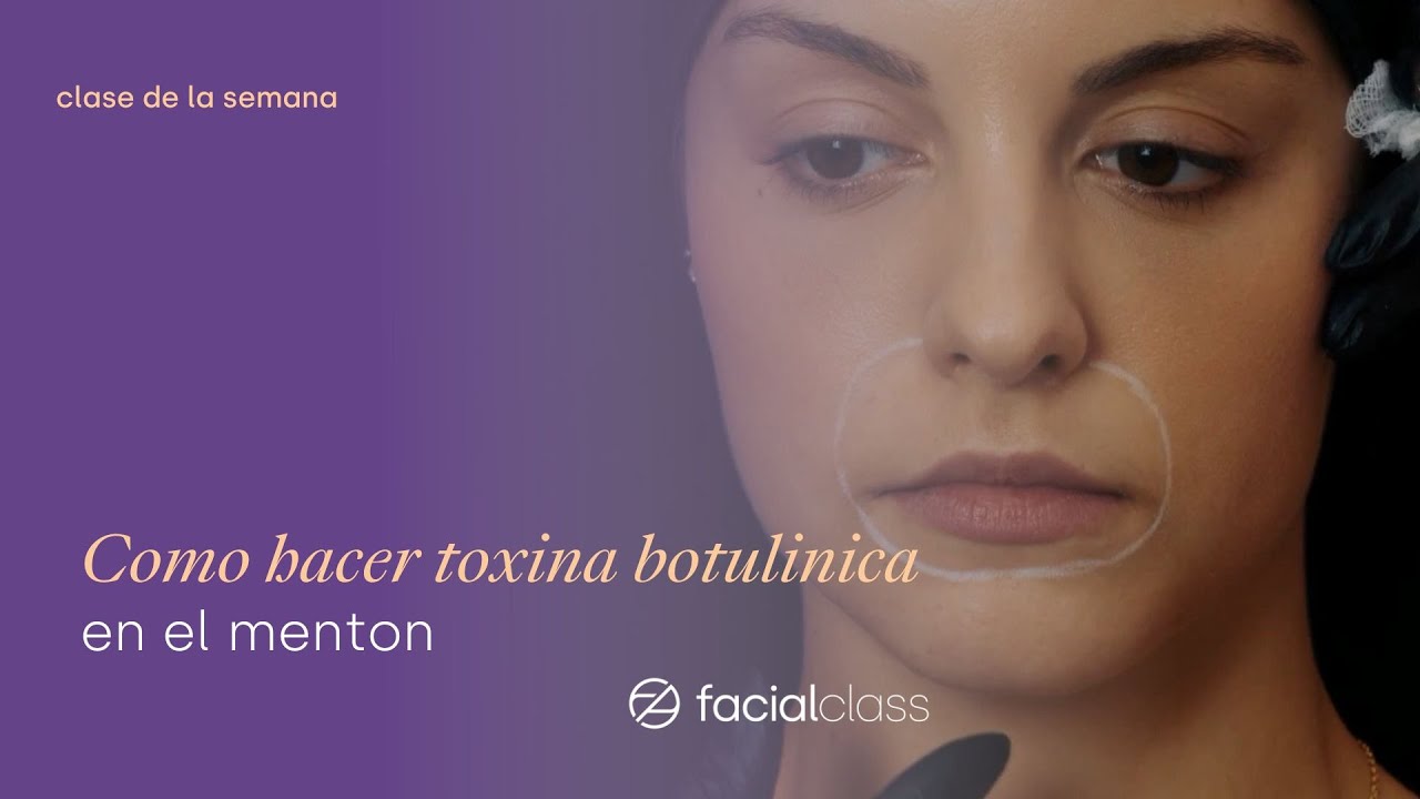 botox en el menton antes y despues