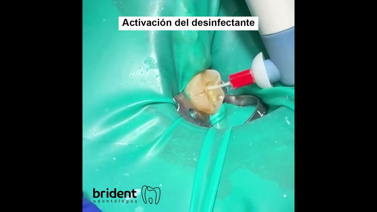 brackets estéticos en santa cruz de tenerife