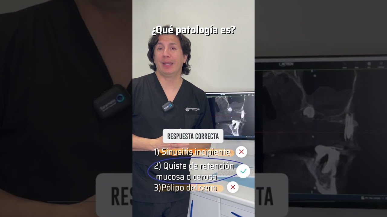 cirugia de quiste en seno maxilar