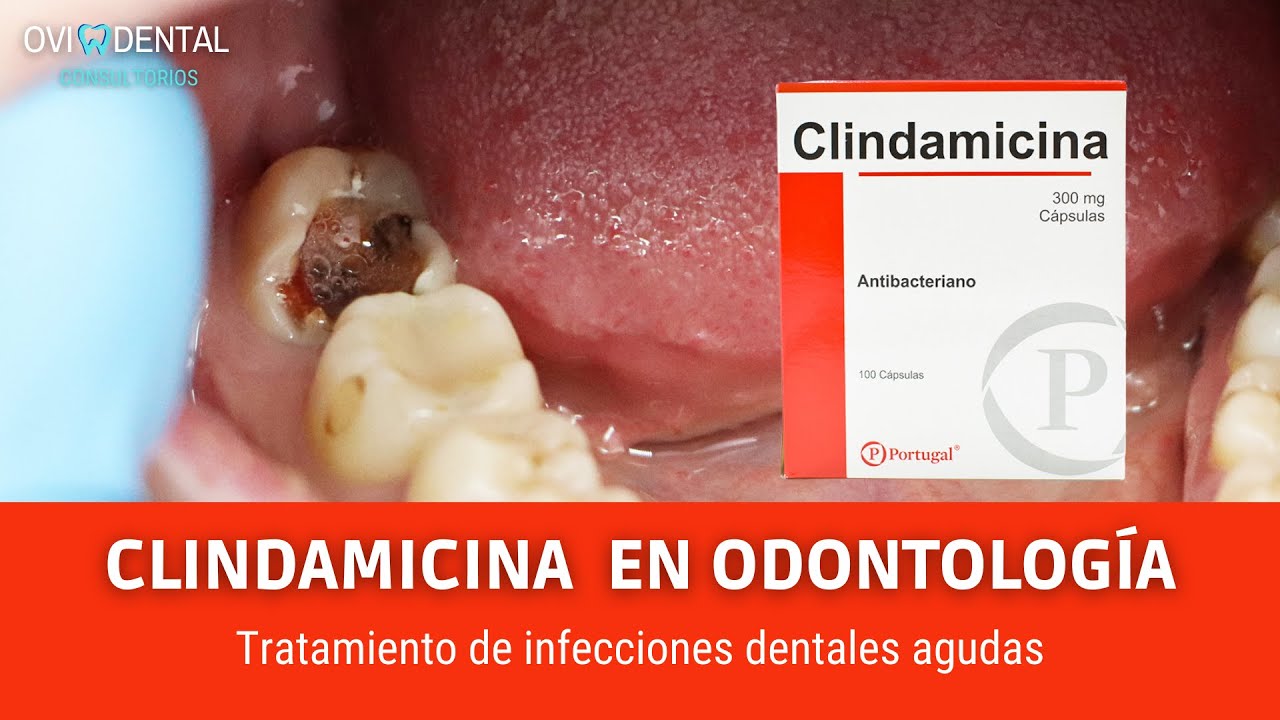 clindamicina 300 mg para infeccion dental