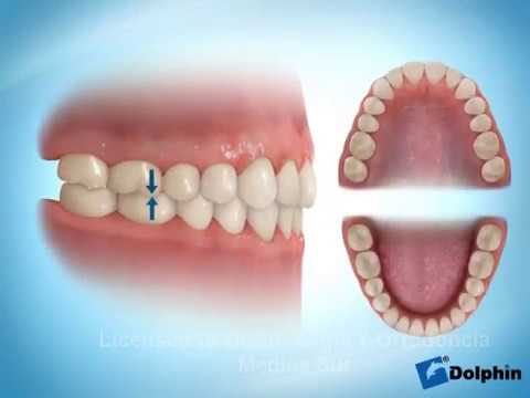 como debe de ser la mordida de los dientes
