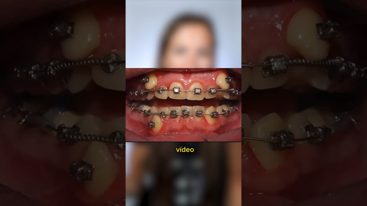 como meter los dientes de arriba