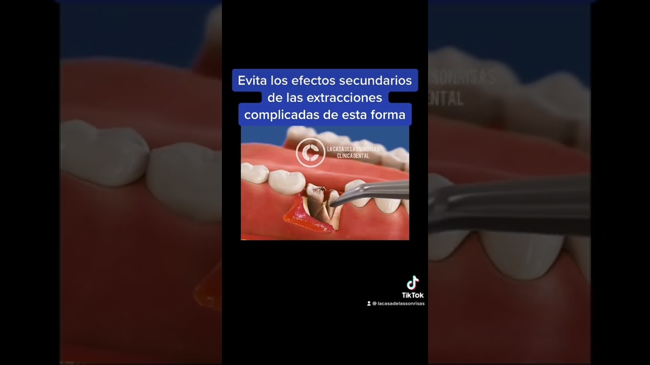 como queda el hueco de una muela