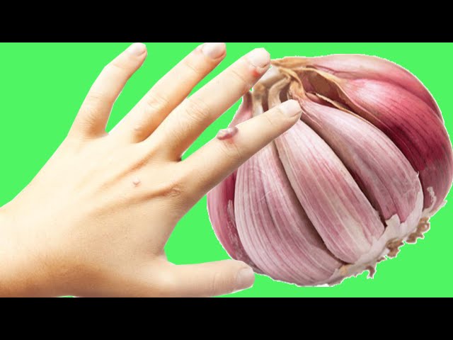 como quitar las verrugas de las manos