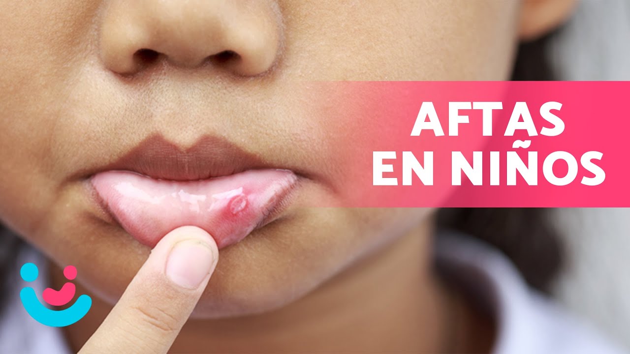 como quitar los fuegos de la lengua de un niño