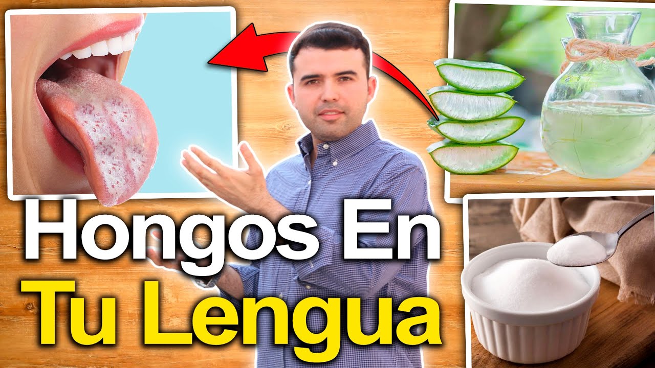 como quitar manchas blancas de la lengua