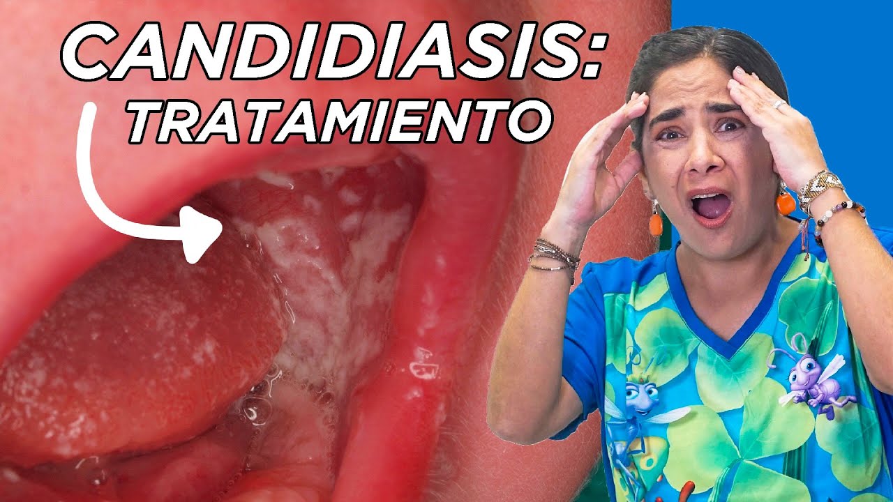 como saber si mi bebe tiene hongos en la boca