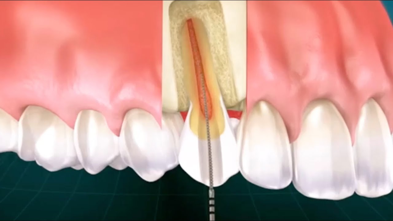 como se hace una endodoncia de un diente