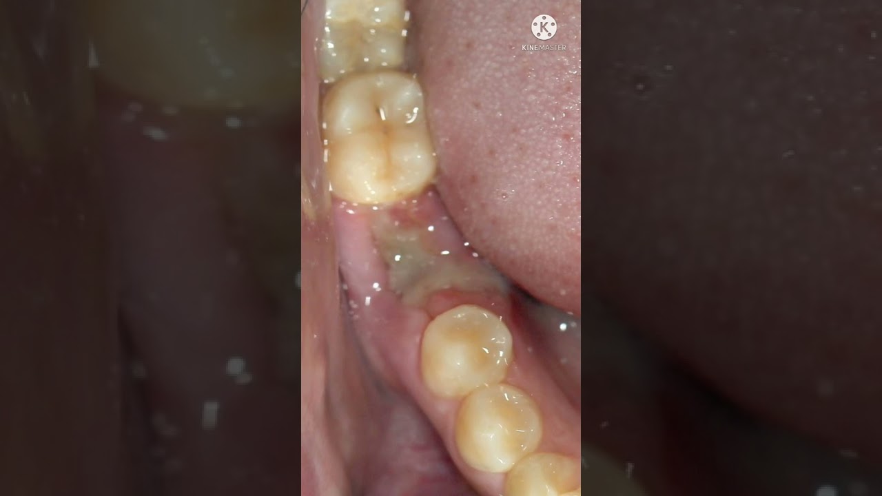 como se ve la encia despues de una extraccion