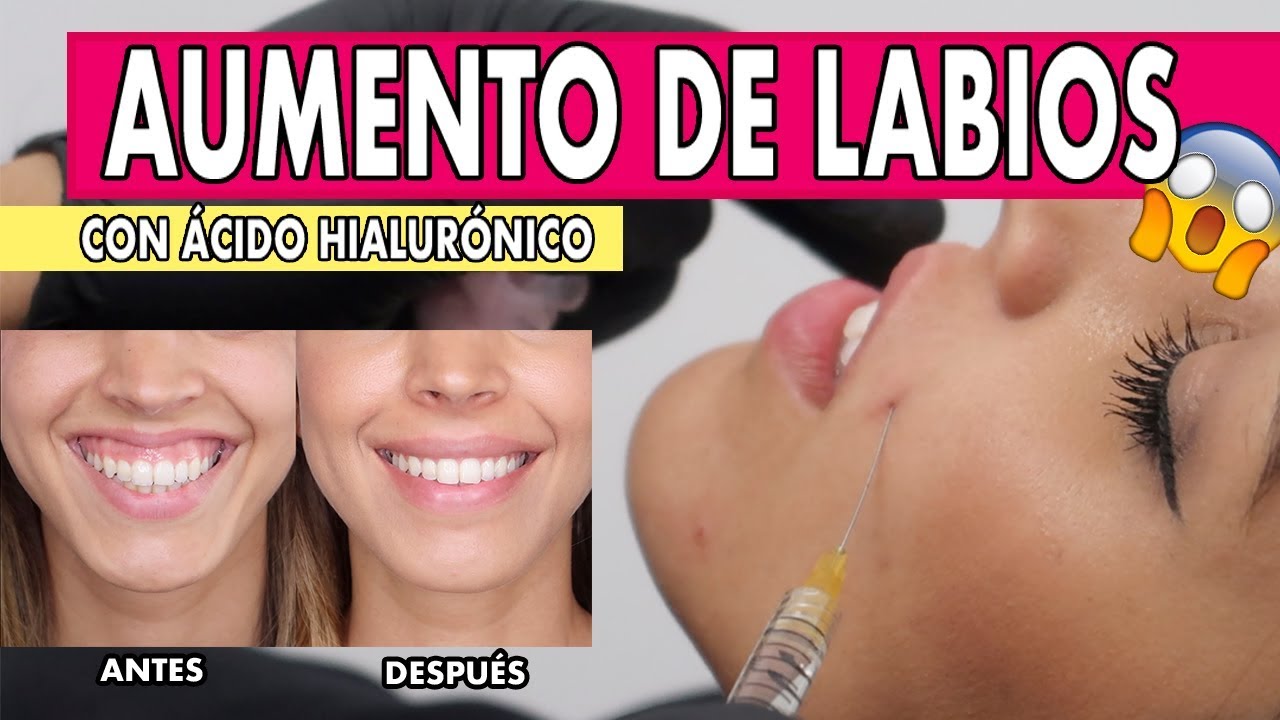 corrección sonrisa gingival con ácido hialurónico