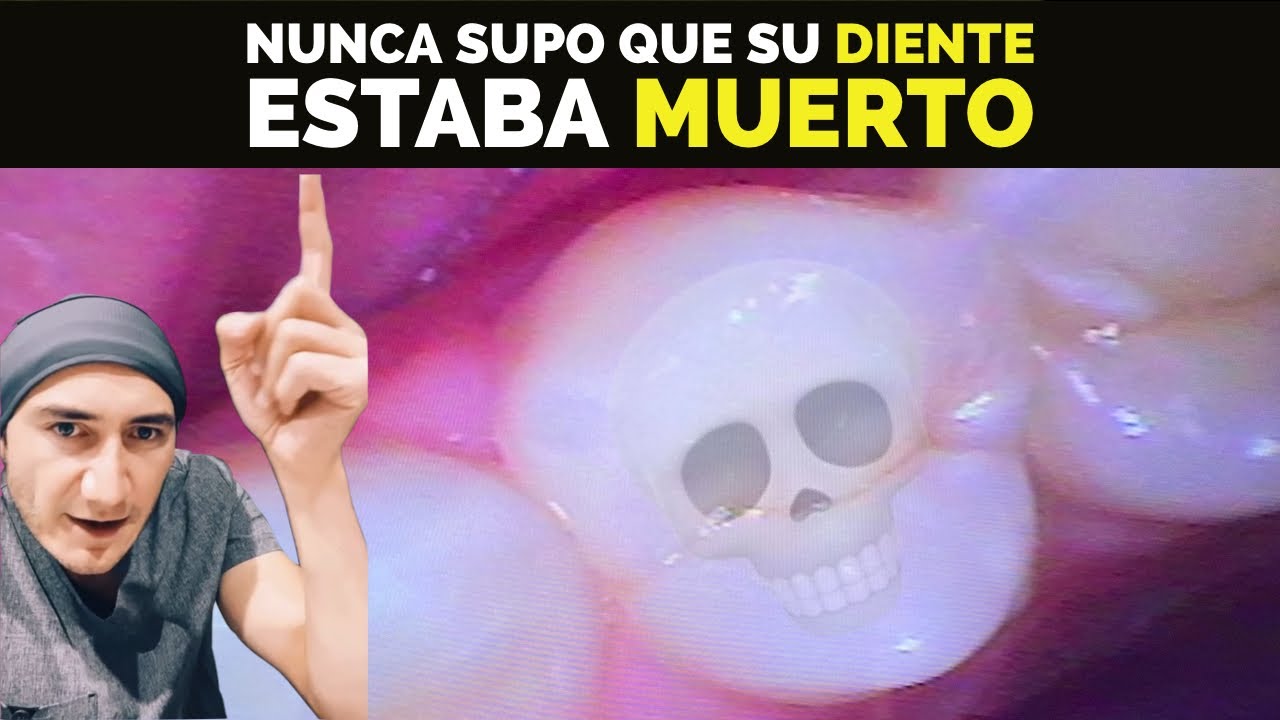 cuanto tarda en morir el nervio de una muela