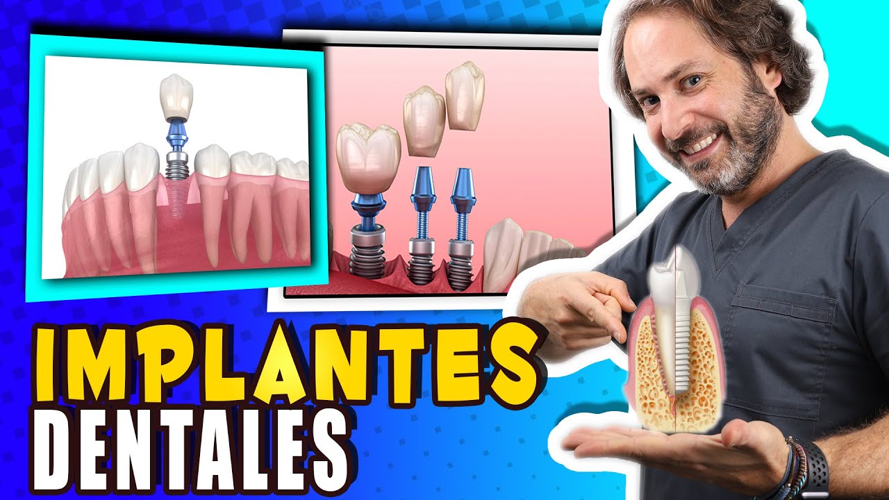 cuantos implantes dentales se pueden poner en un día
