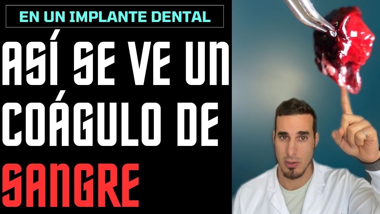 de que color es el coágulo de una muela