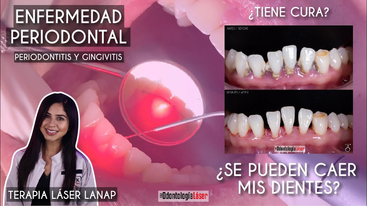 enfermedad que se caen los dientes