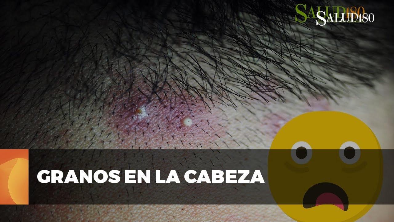 granitos de grasa en la cabeza