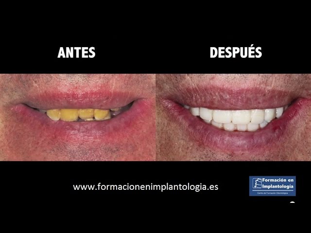 implantes dentales en toda la boca
