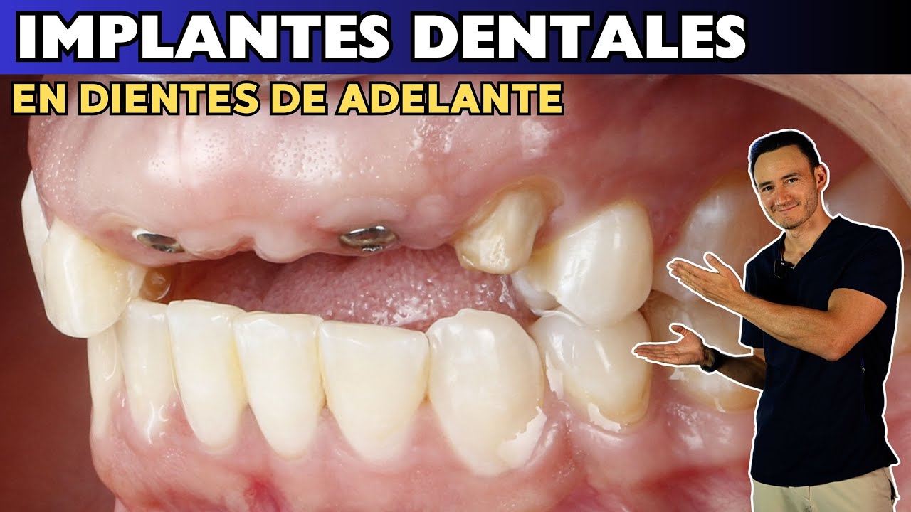 implantes dentales fotos antes y despues