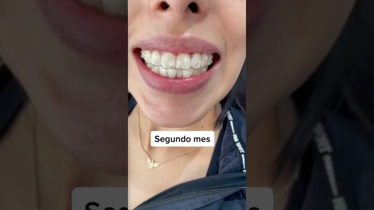 invisalign no encaja en un diente foro
