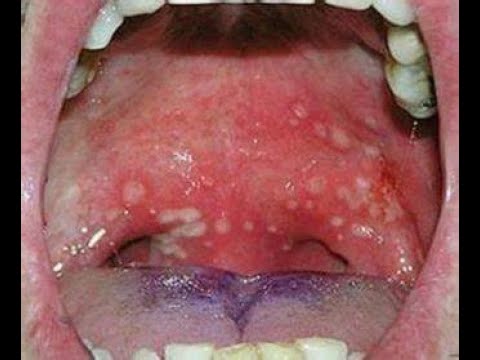 llagas en la boca y fiebre niños