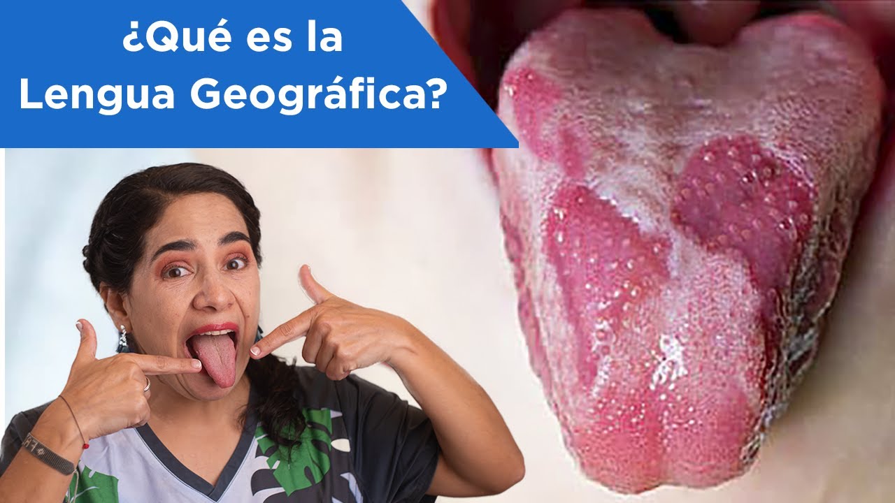 manchas en la lengua que significa