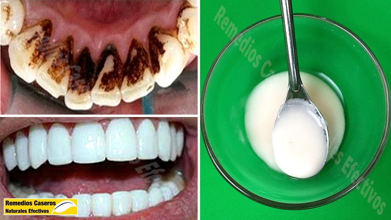 manchas negras en los dientes remedios caseros