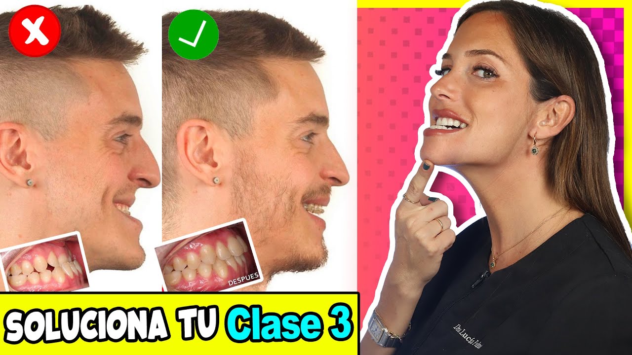 mordida clase 3 antes y despues