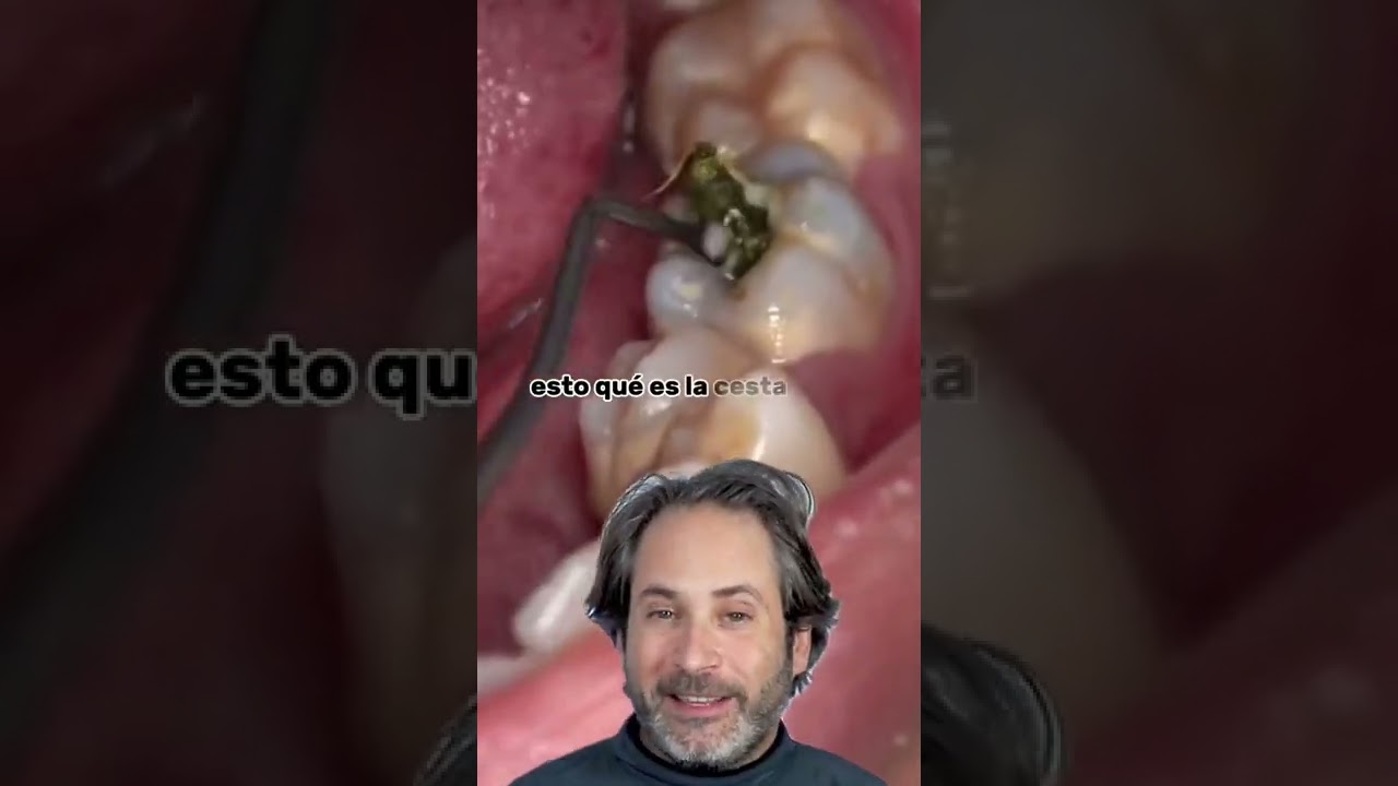 muela de leche con caries profunda