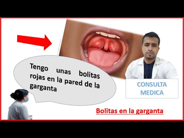 porque tengo puntos rojos en la garganta