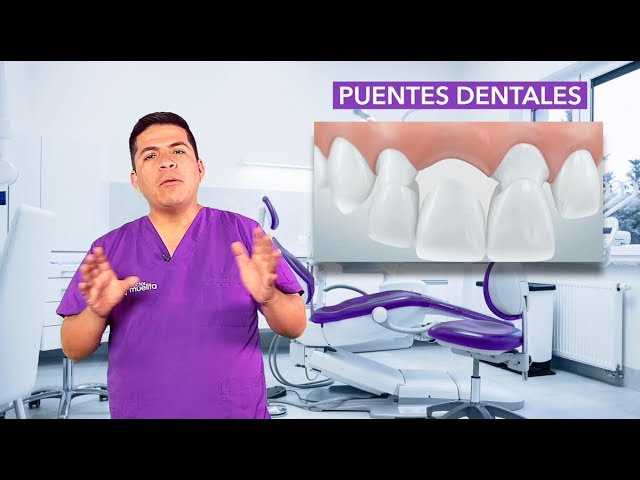 puente dental fijo de 4 piezas precio