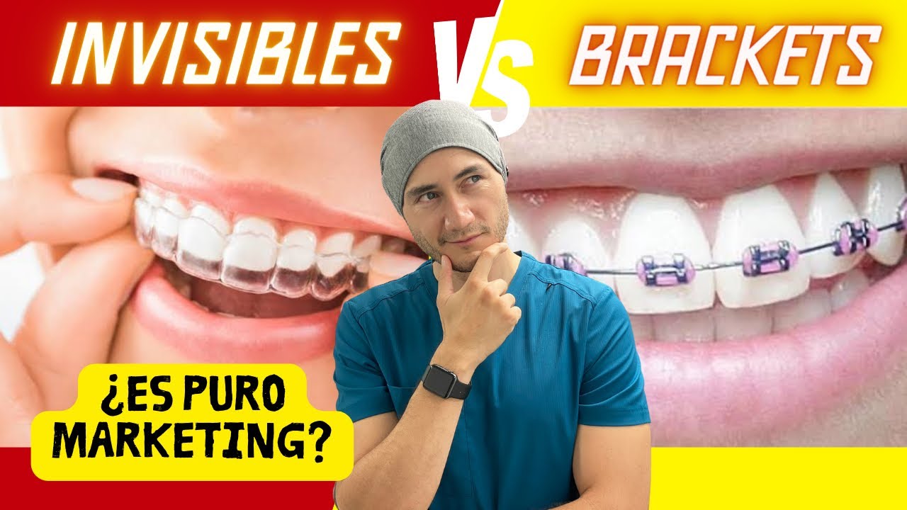 que es mejor brackets o invisalign