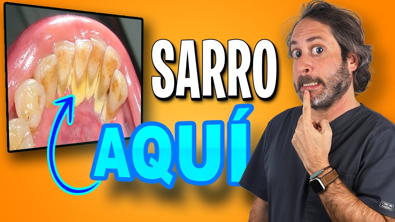 que provoca el sarro en los dientes
