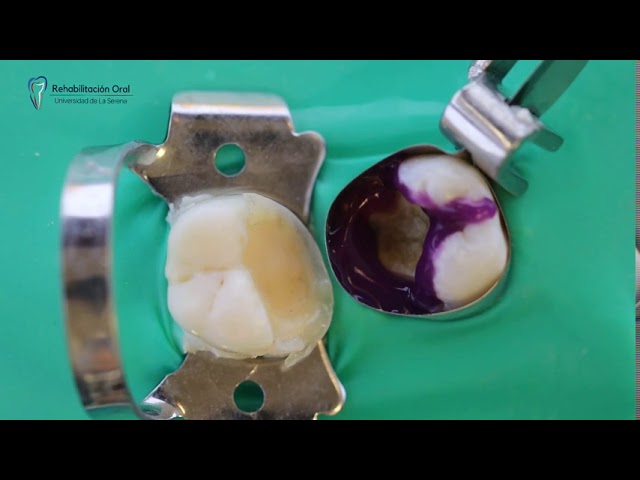 recortador de margen gingival o cincel de esmalte
