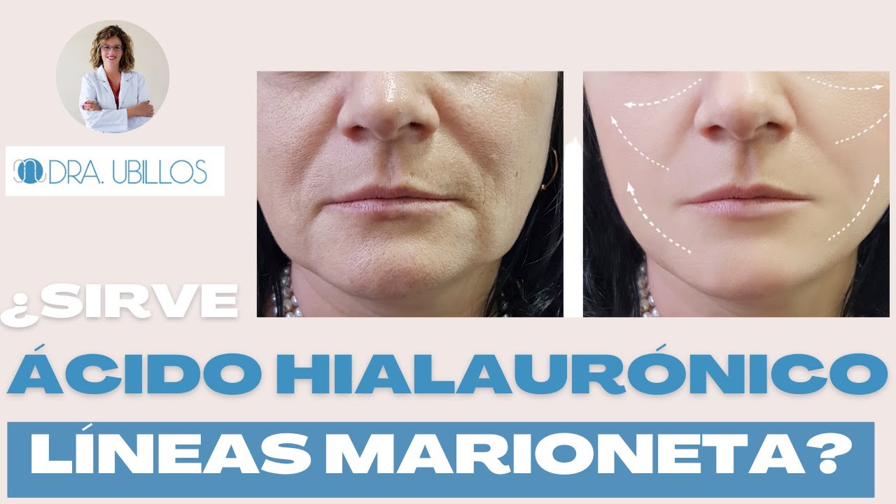 ácido hialurónico líneas de marioneta opiniones