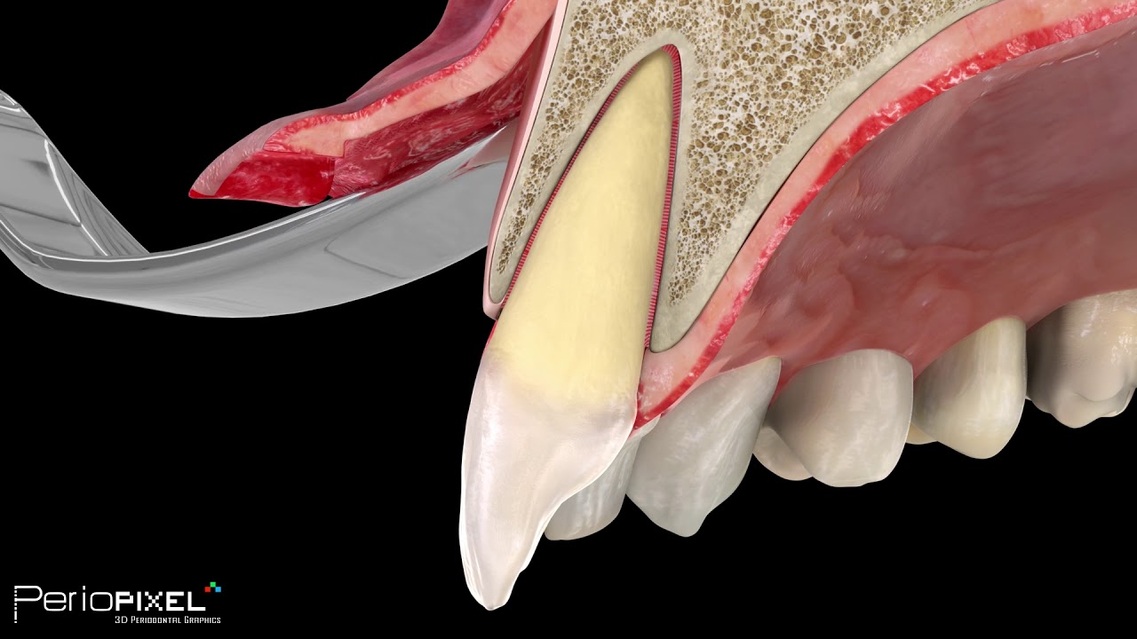 alargamiento de dientes antes y despues