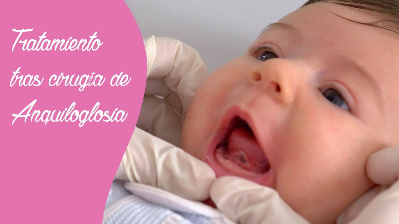 cirugia de frenillo lingual en niños