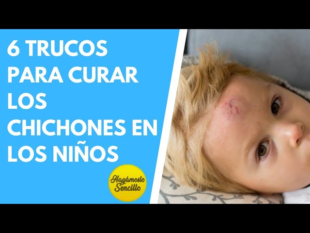 como desinflamar un chichon en la frente