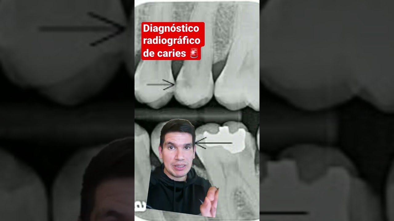 como se ve una caries en una radiografia