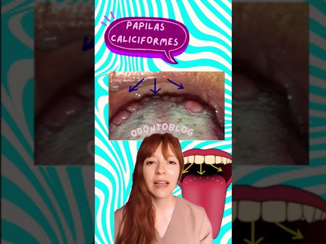 como se ven las papilas gustativas inflamadas