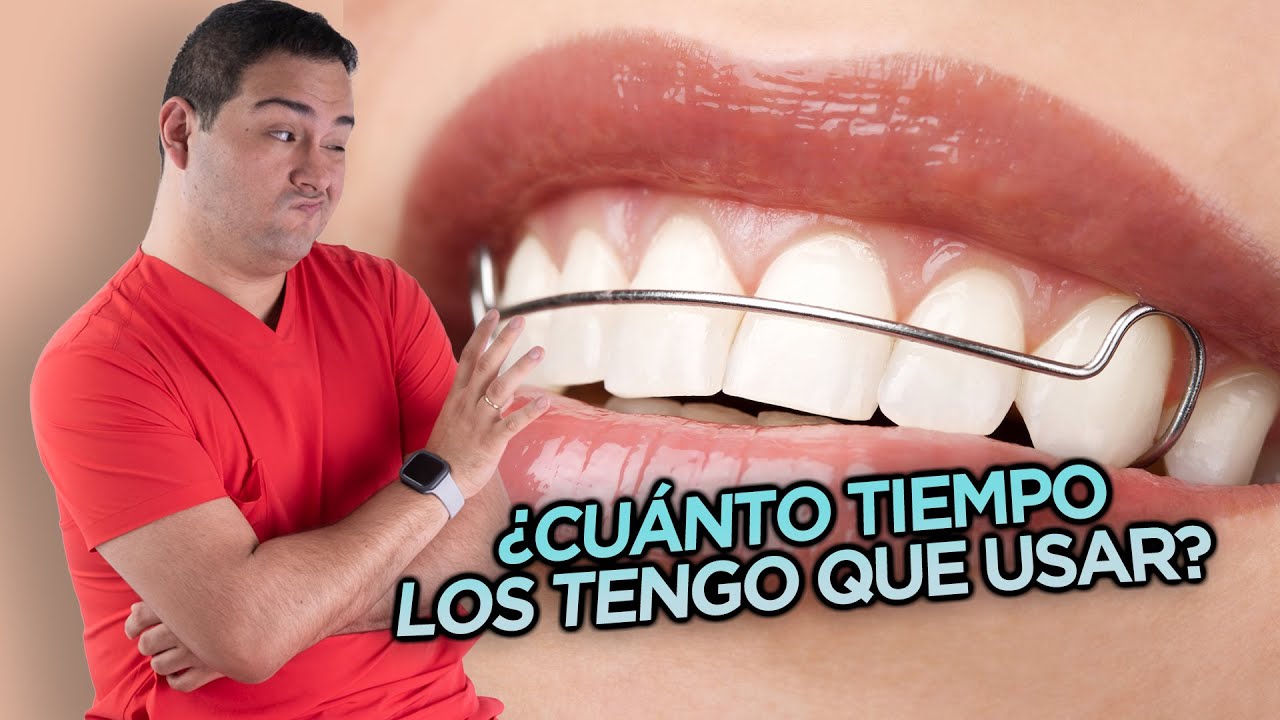 como tienen que quedar los retenedores