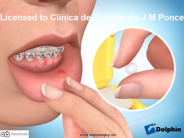 crema para las heridas de los brackets
