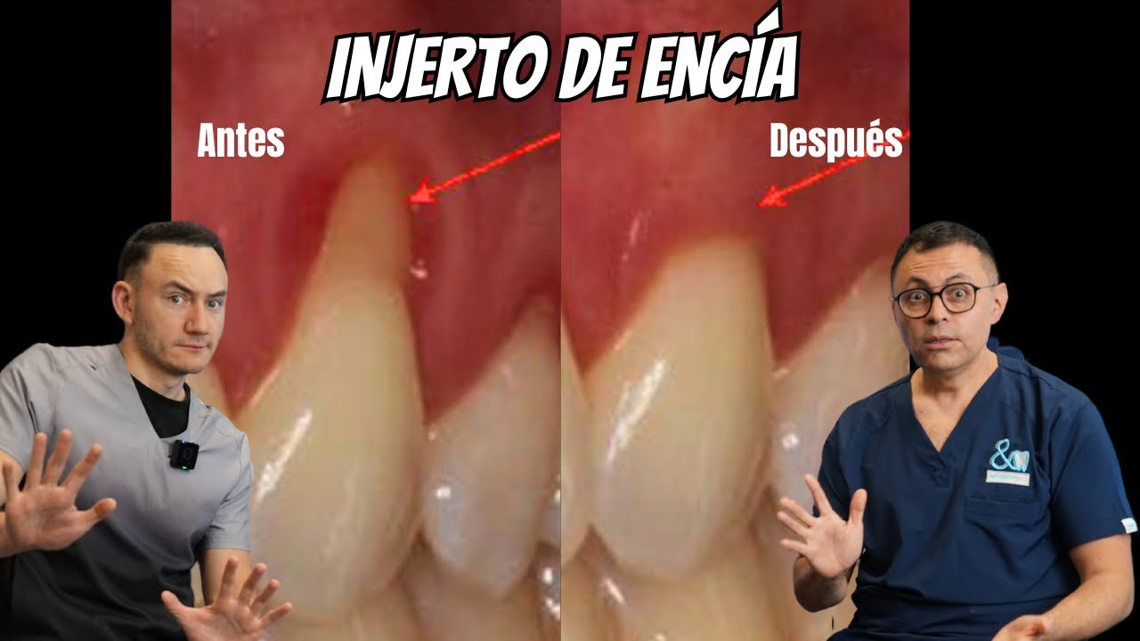 cuanto cuesta un injerto de encia