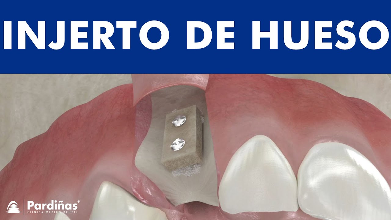 cuidados después de un injerto de hueso en la boca