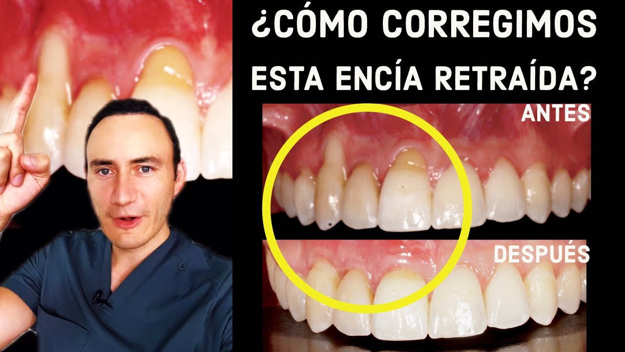 después de un curetaje las encías vuelven a su sitio