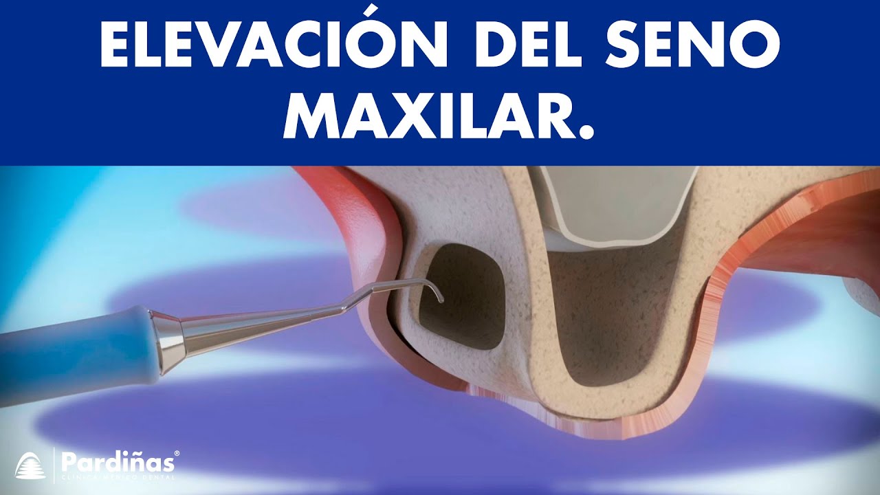 elevación de seno maxilar y colocación de implantes