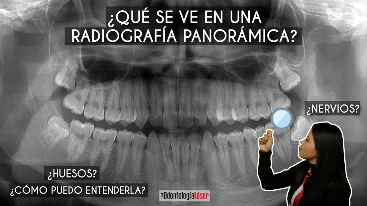 en una radiografía dental se ve una infección