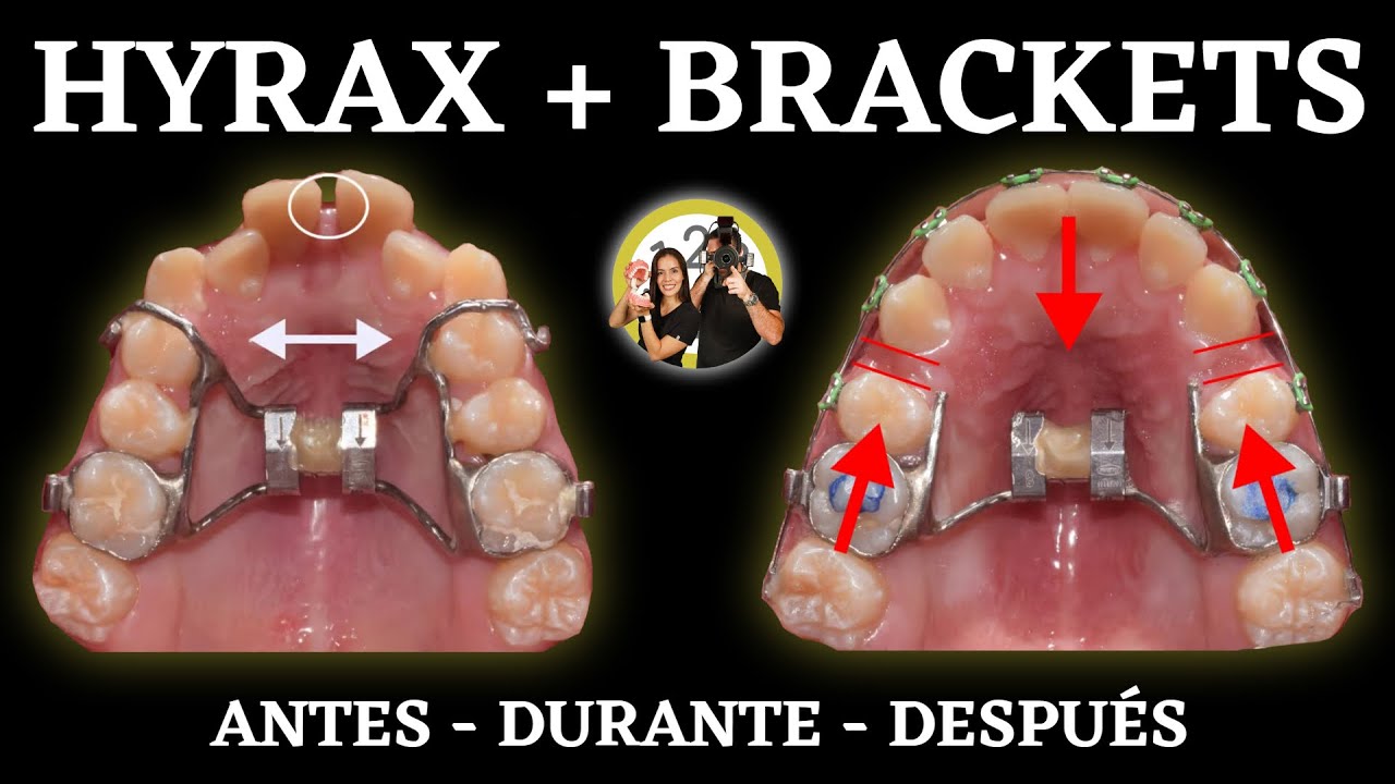 expansor de paladar antes y despues