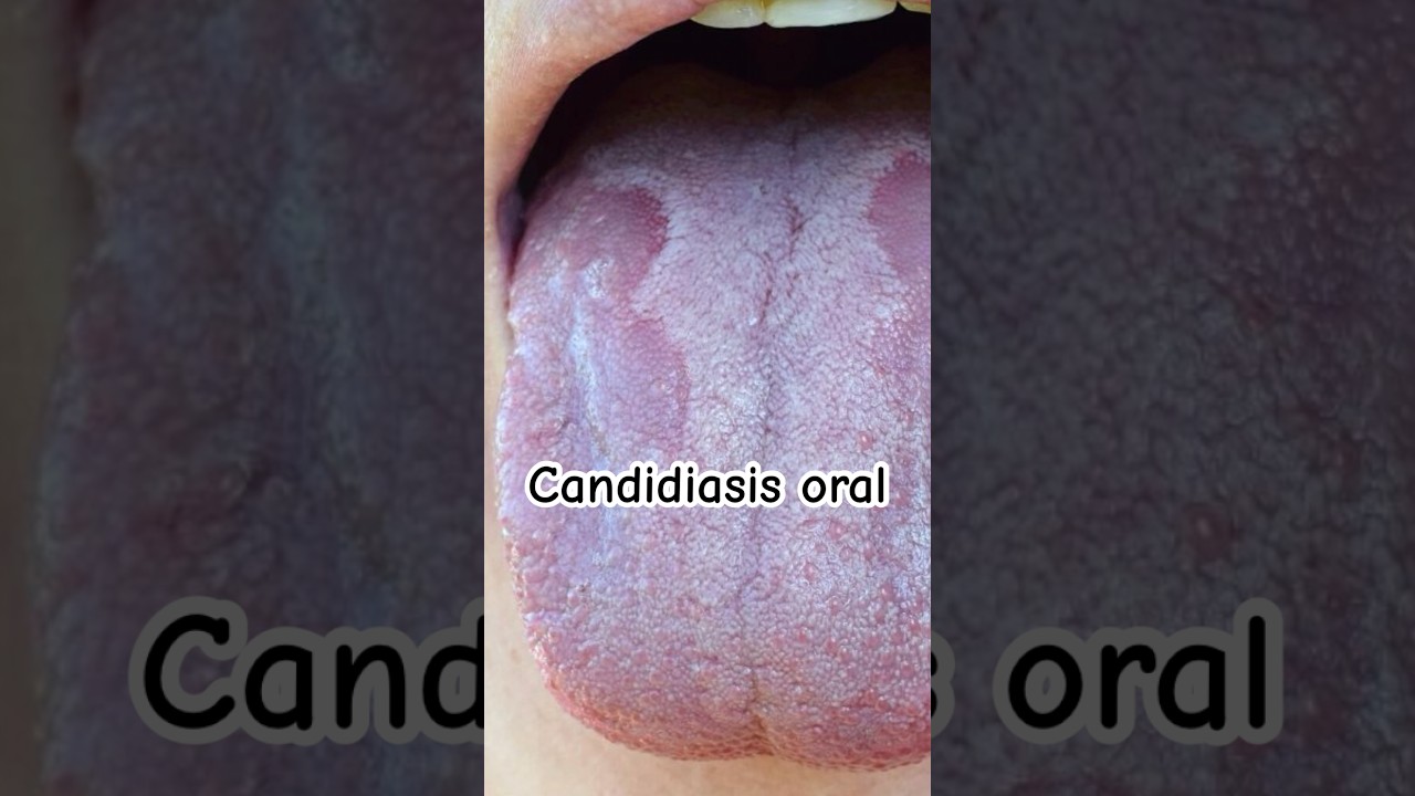 hongos en la lengua se pegan